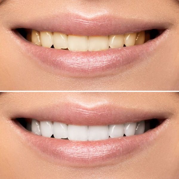 Blanchiment-Dentaire-casablanca-rabat-institut-de-beaute-Bloom-Clinic